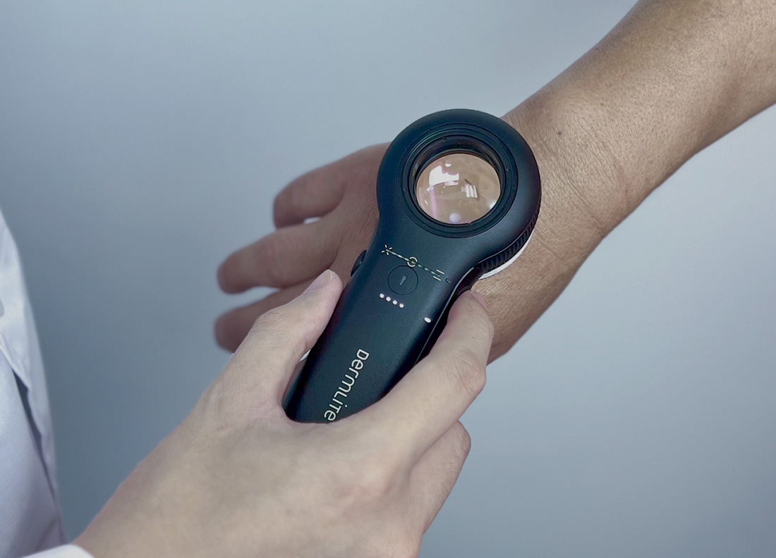 Dermlite Dl5 Dermatoscope Review - Molemax Systems