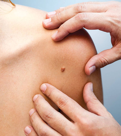 Skin markings to differentiate benign from malignant lesions: A prospective observational study
