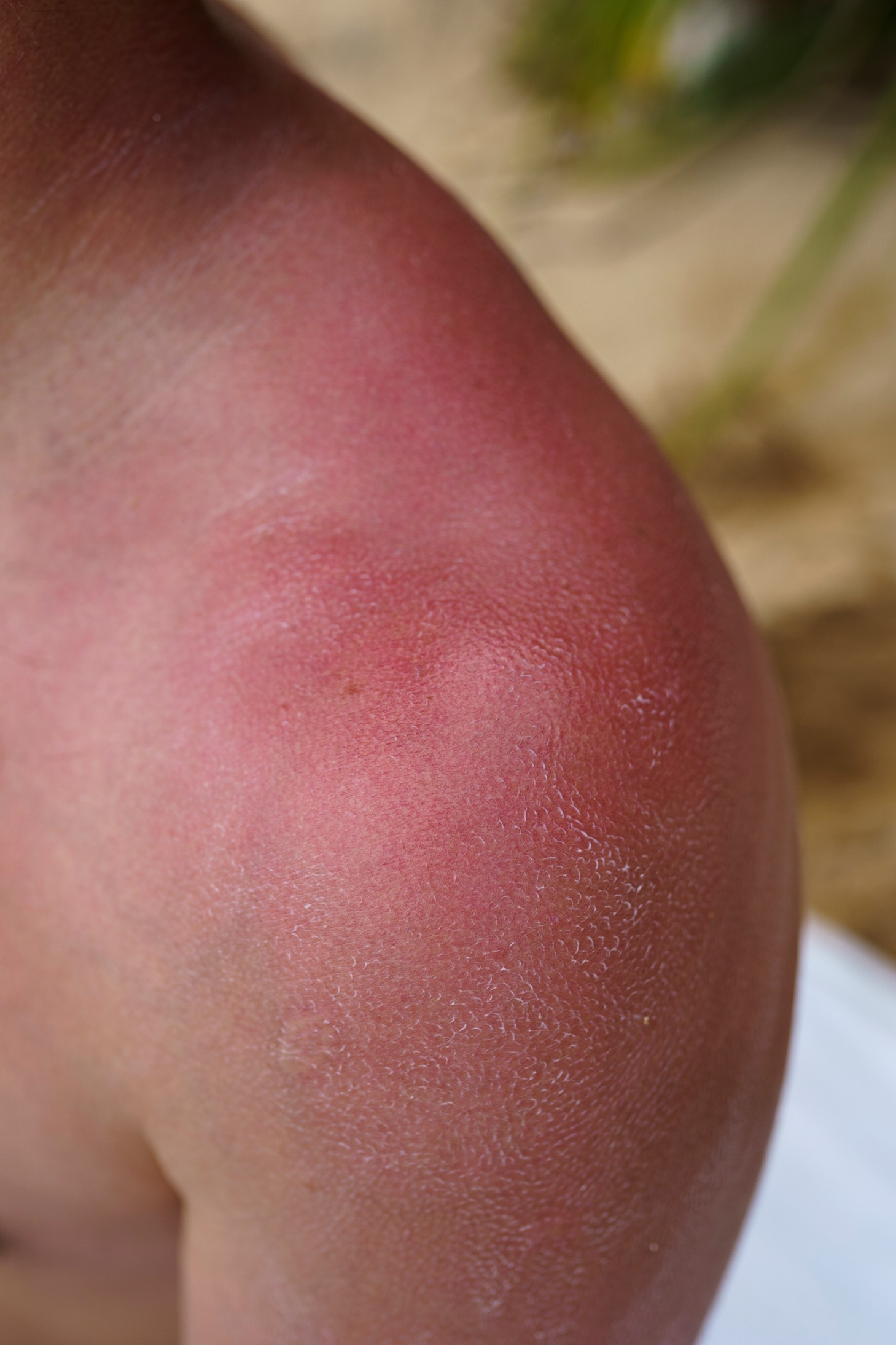 Melanoma on Chronically Sun-Damaged Skin: Deciphering Gene Expression Signatures