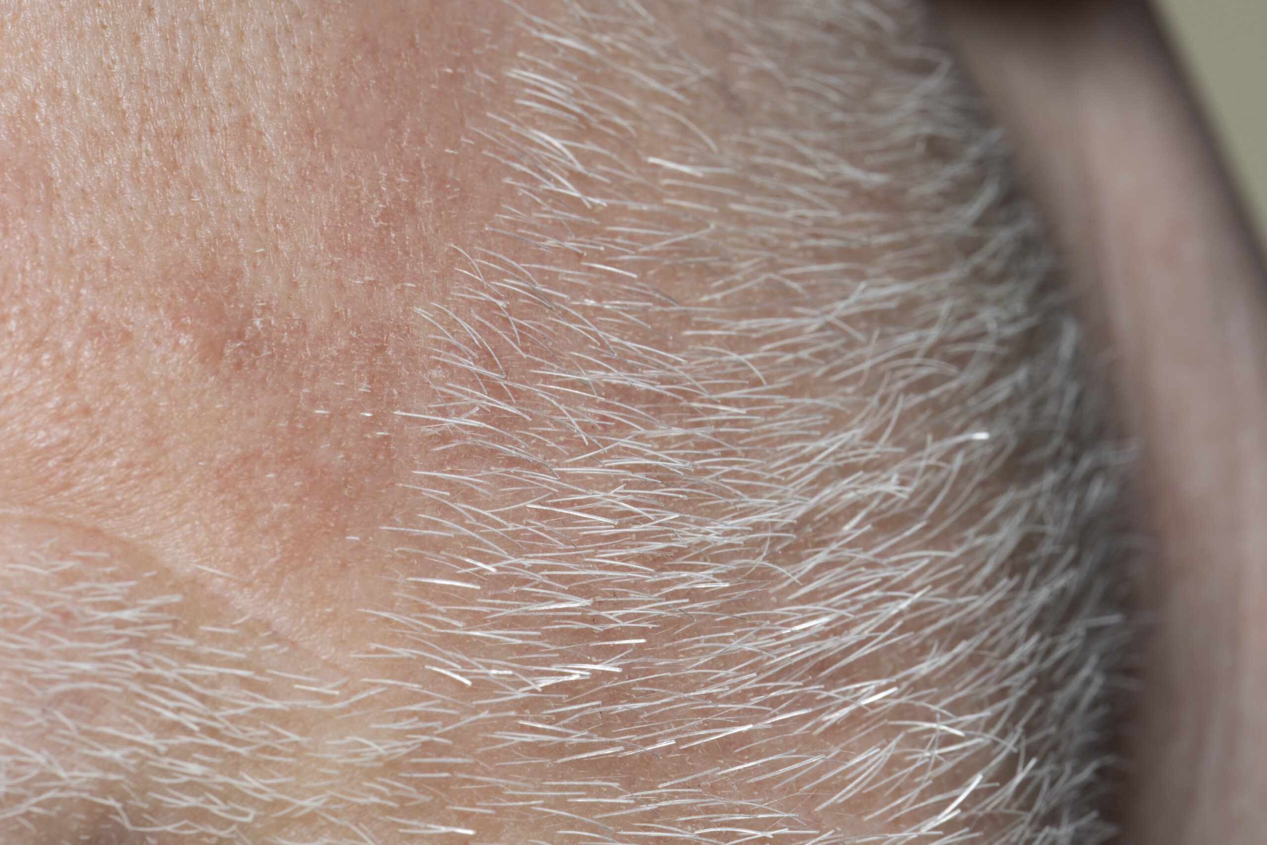 Dermoscopic Features of Follicular Dermatoses: A Cross-Sectional Study