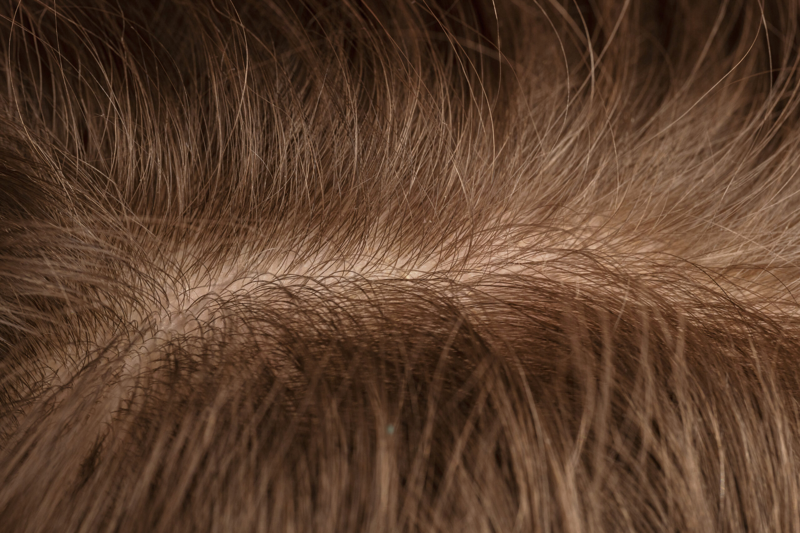 The Evaluation of Clinical and Dermatoscopic Features of Scalp Nevi in Adults