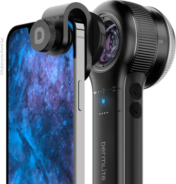 DermLite DL5 Plus Dermatoscope